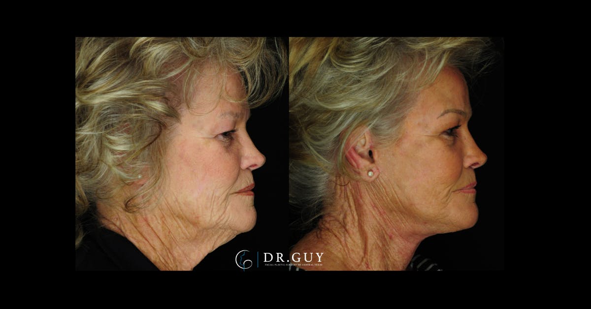 Facelift Before & After Gallery - Patient 253717 - Image 2