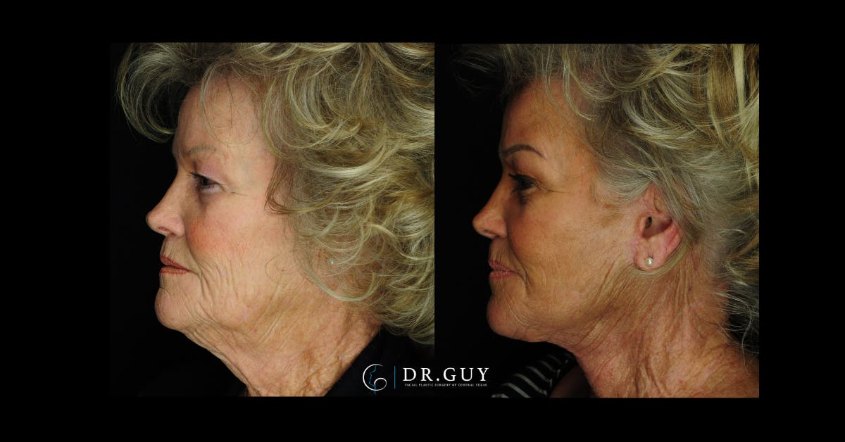 Facelift Before & After Gallery - Patient 253717 - Image 3