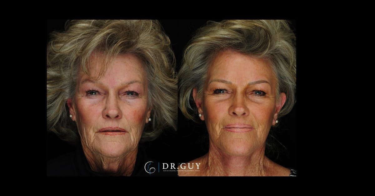Facelift Before & After Gallery - Patient 253717 - Image 4