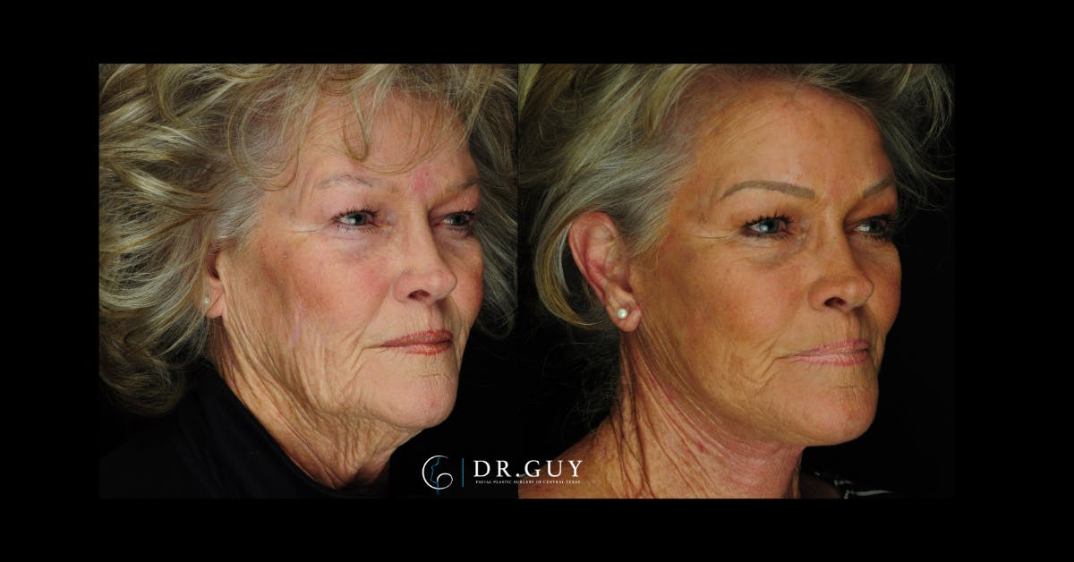 Facelift Before & After Gallery - Patient 253717 - Image 5