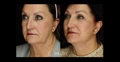 Facelift Before & After Gallery - Patient 188242 - Image 1