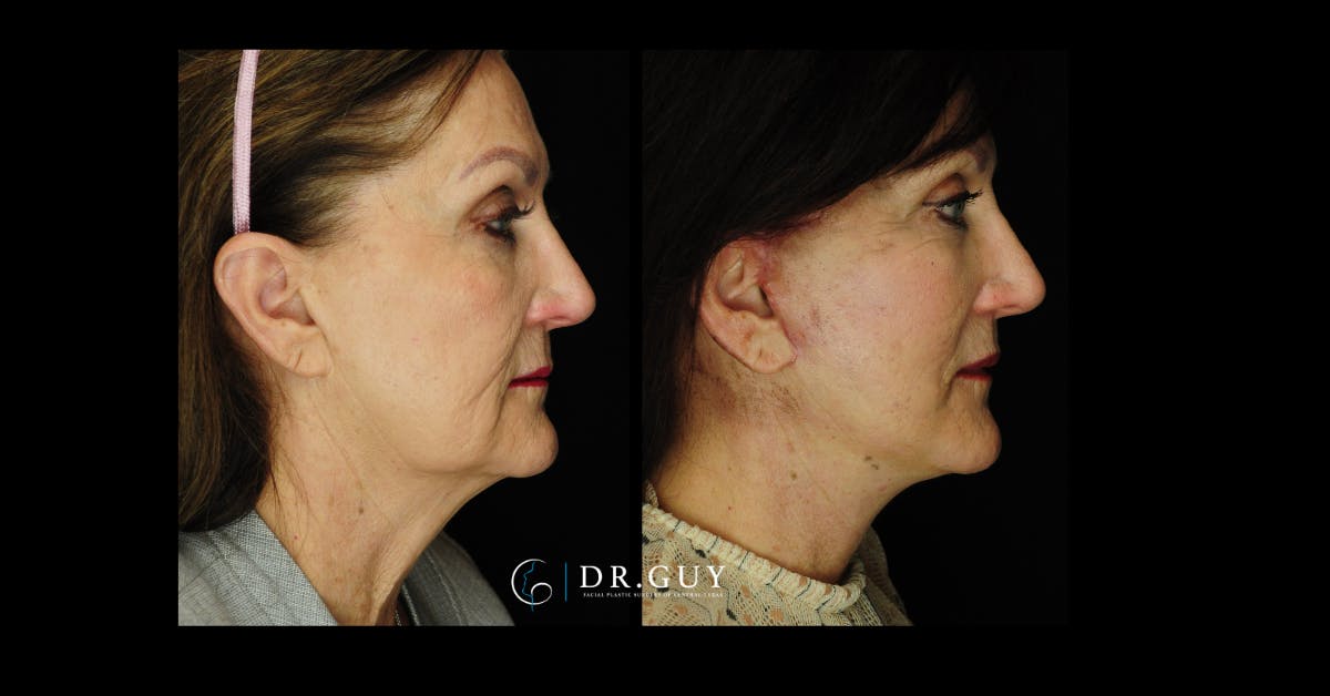 Facelift Before & After Gallery - Patient 188242 - Image 2