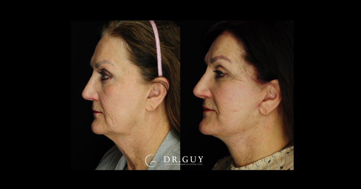 Facelift Before & After Gallery - Patient 188242 - Image 3
