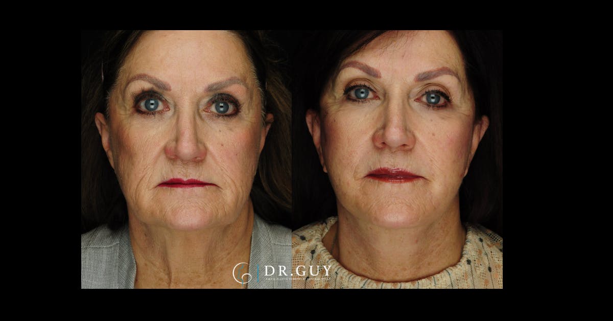 Facelift Before & After Gallery - Patient 188242 - Image 4