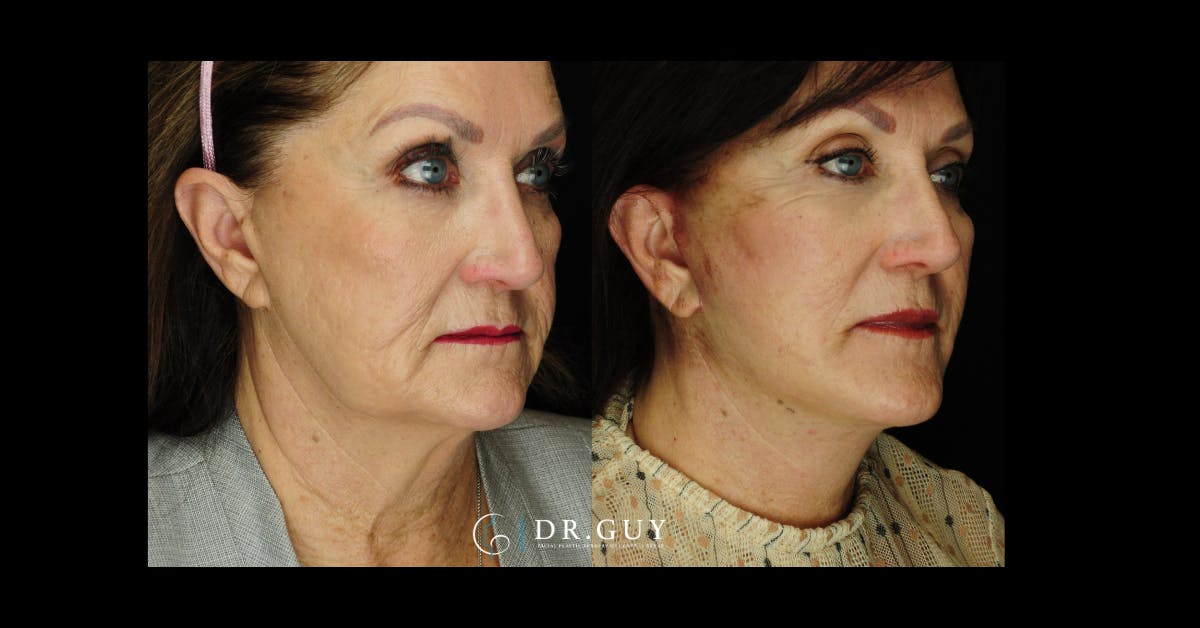 Facelift Before & After Gallery - Patient 188242 - Image 5
