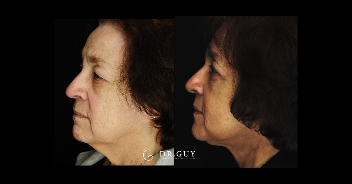 Facelift Before & After Gallery - Patient 290077 - Image 2