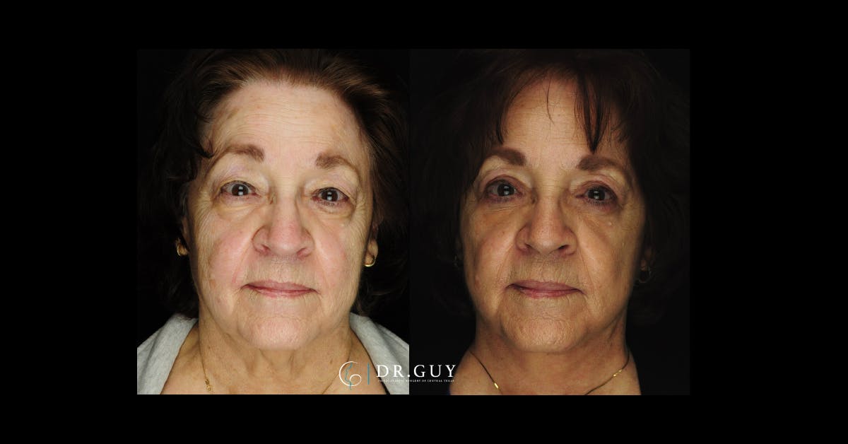 Facelift Before & After Gallery - Patient 290077 - Image 3