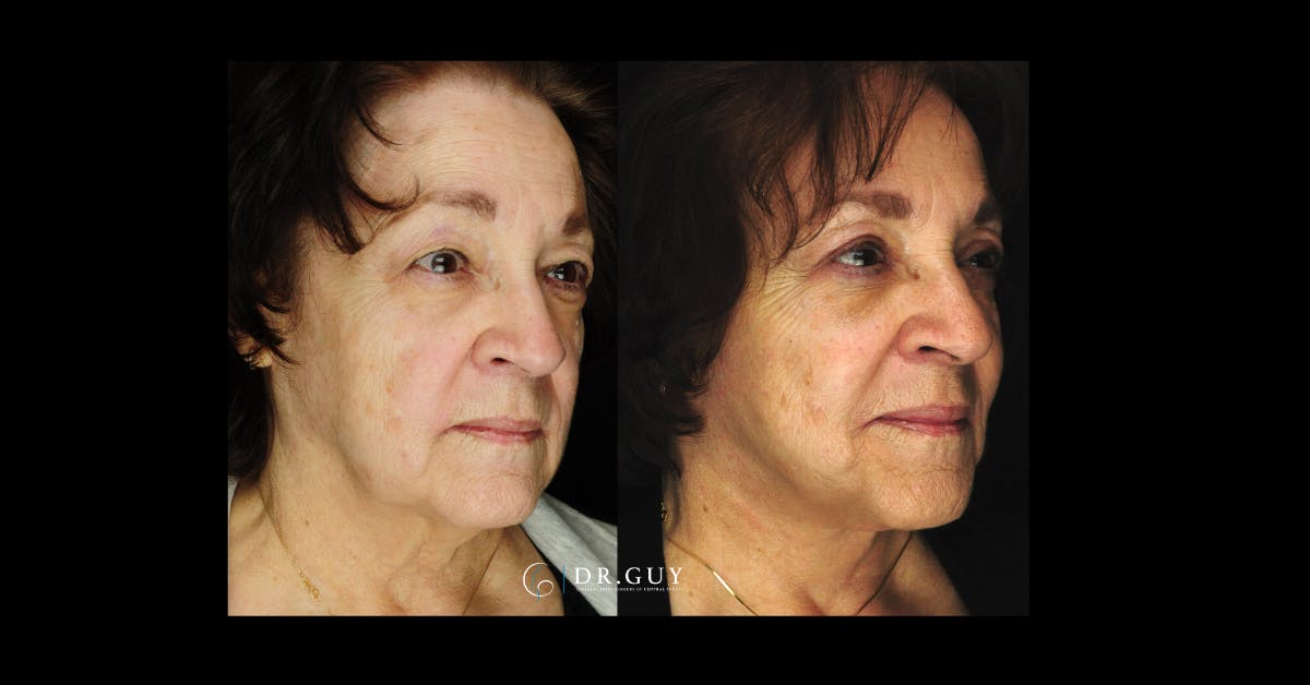 Facelift Before & After Gallery - Patient 290077 - Image 4