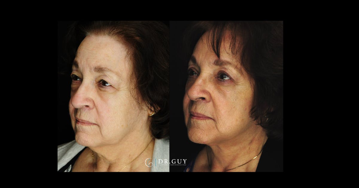 Facelift Before & After Gallery - Patient 290077 - Image 5