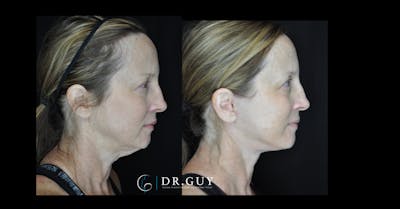 Facelift Before & After Gallery - Patient 380148 - Image 1
