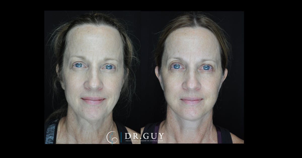 Facelift Before & After Gallery - Patient 380148 - Image 2
