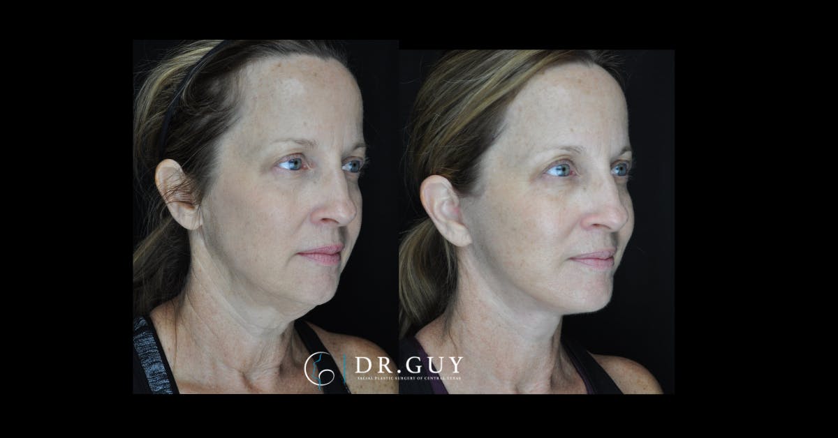 Facelift Before & After Gallery - Patient 380148 - Image 3