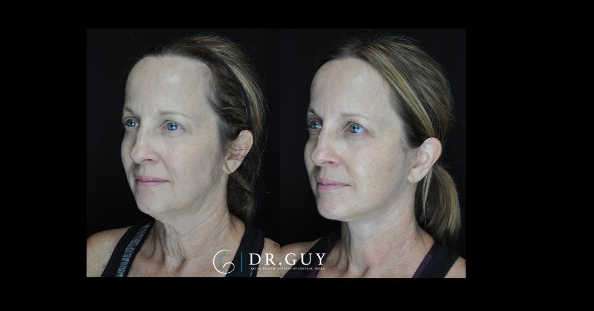 Facelift Before & After Gallery - Patient 380148 - Image 4
