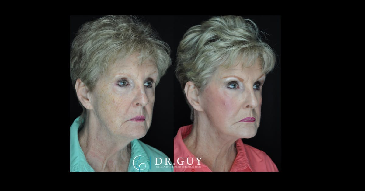 Facelift Before & After Gallery - Patient 330742 - Image 1