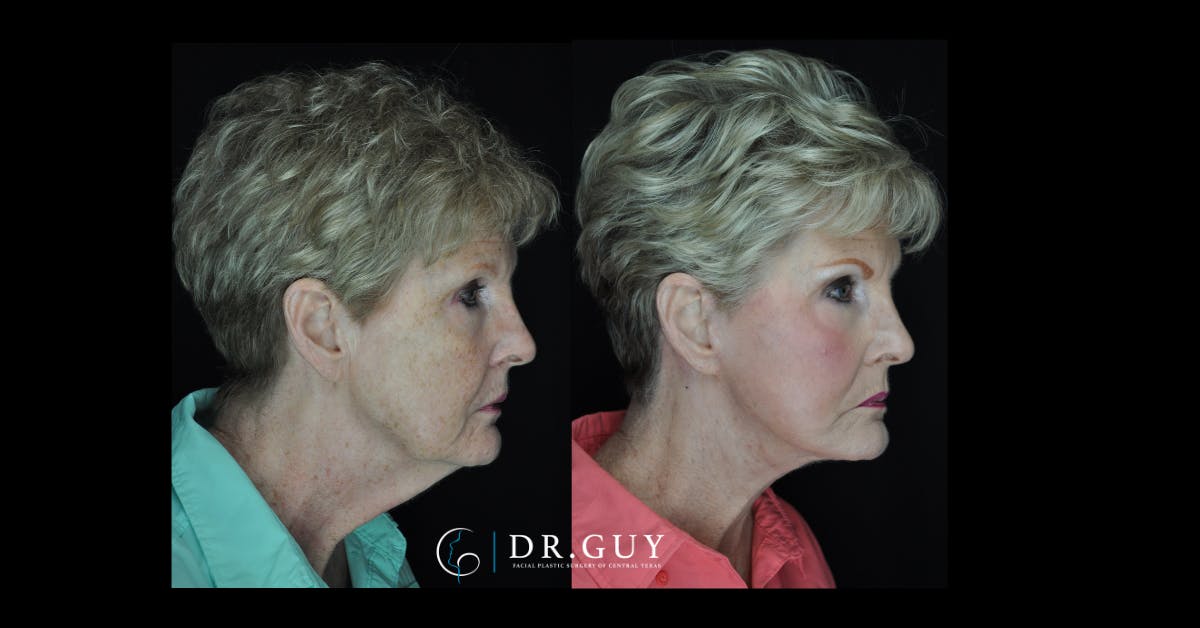 Facelift Before & After Gallery - Patient 330742 - Image 2