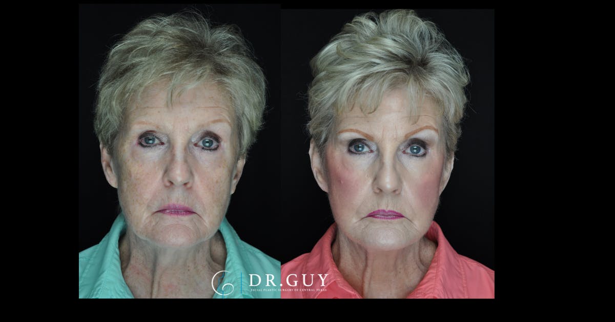 Facelift Before & After Gallery - Patient 330742 - Image 3