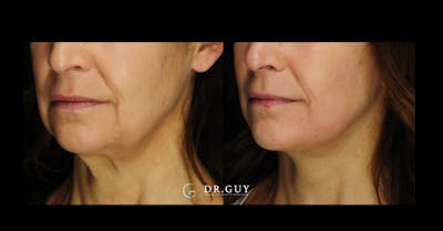 Facelift Before & After Gallery - Patient 107507 - Image 1