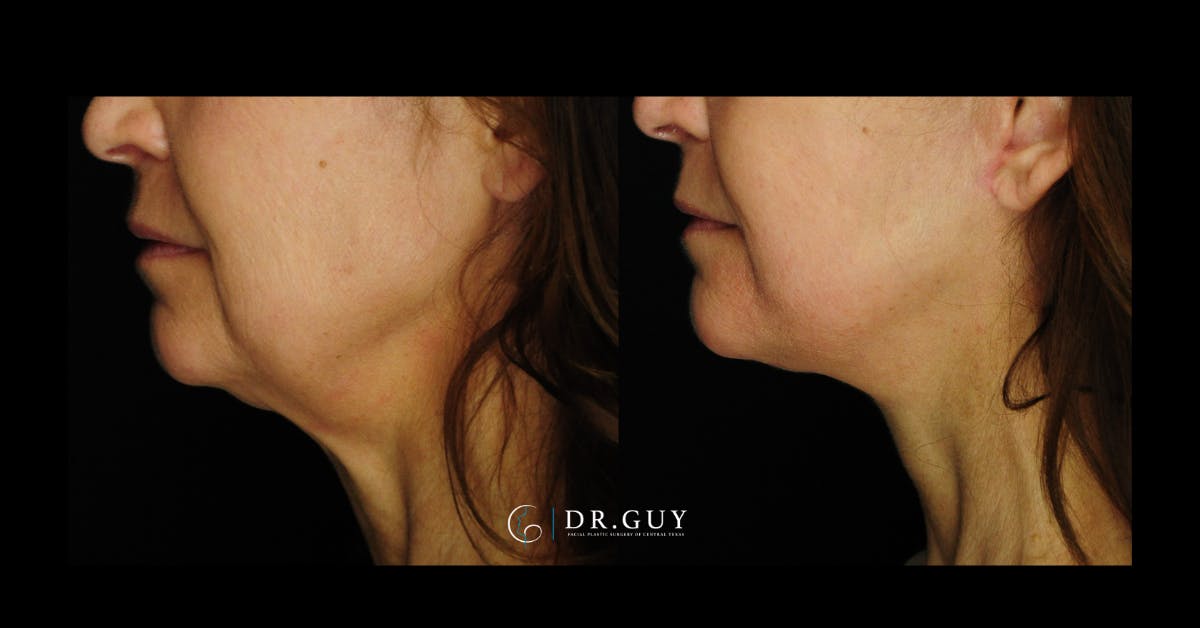 Facelift Before & After Gallery - Patient 107507 - Image 2