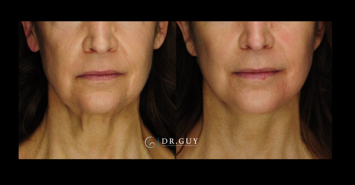 Facelift Before & After Gallery - Patient 107507 - Image 3