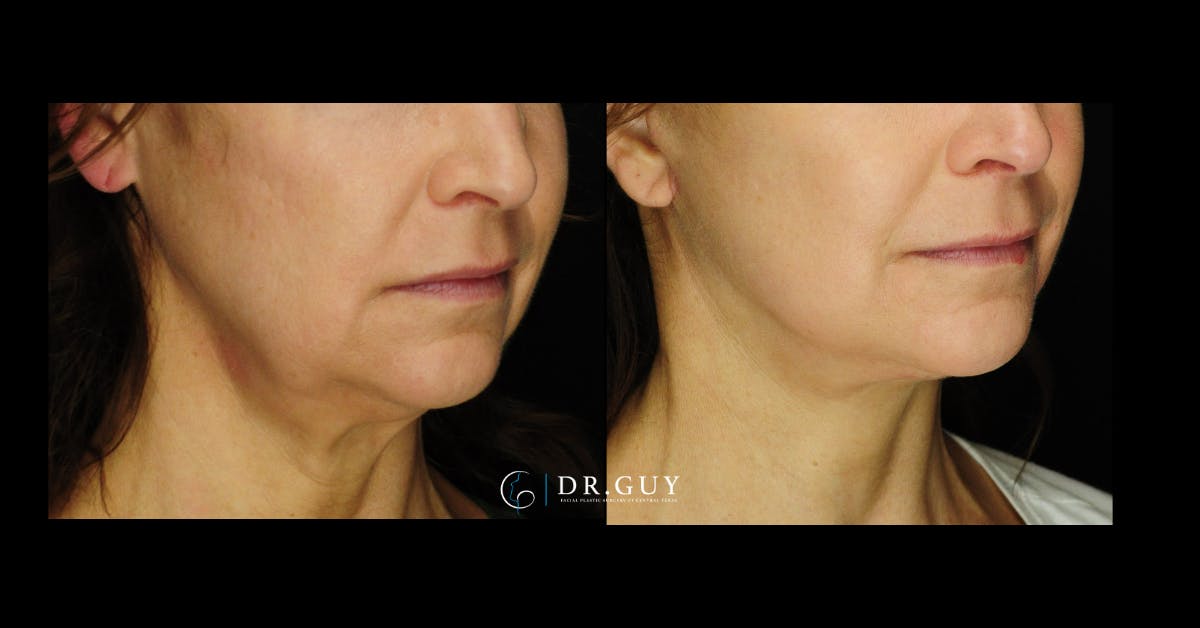 Facelift Before & After Gallery - Patient 107507 - Image 4