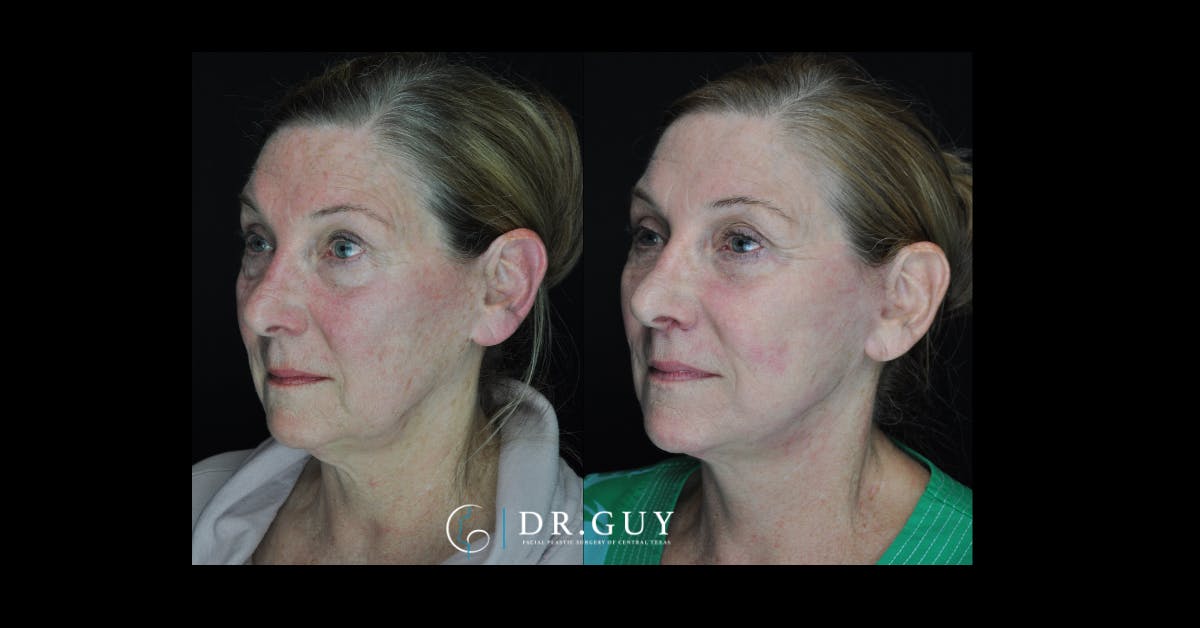 Facelift Before & After Gallery - Patient 184546 - Image 1