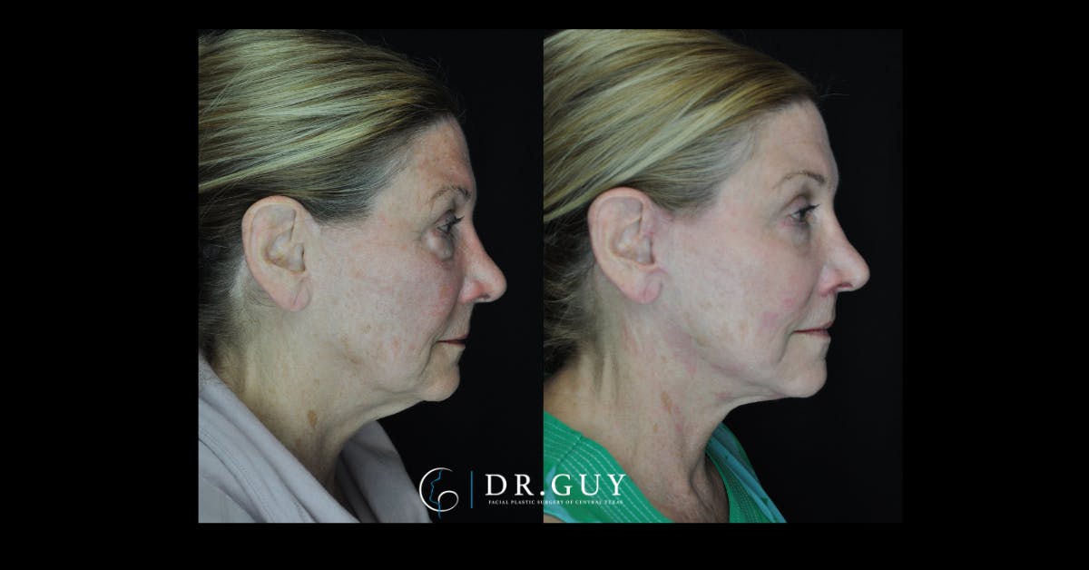 Facelift Before & After Gallery - Patient 184546 - Image 2