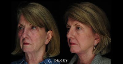 Facelift Before & After Gallery - Patient 342831 - Image 1