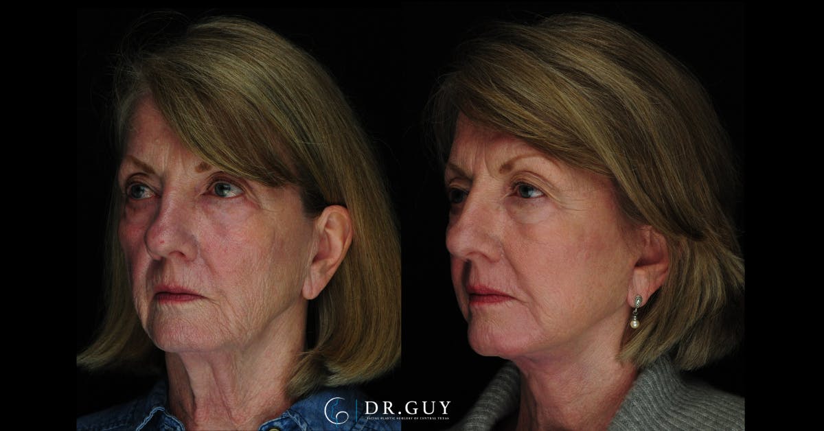 Facelift Before & After Gallery - Patient 342831 - Image 1