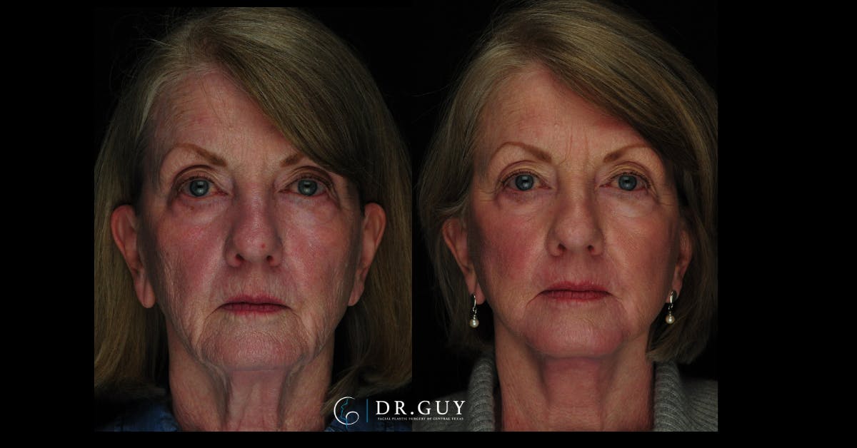 Facelift Before & After Gallery - Patient 342831 - Image 3