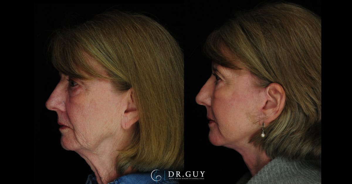 Facelift Before & After Gallery - Patient 342831 - Image 4