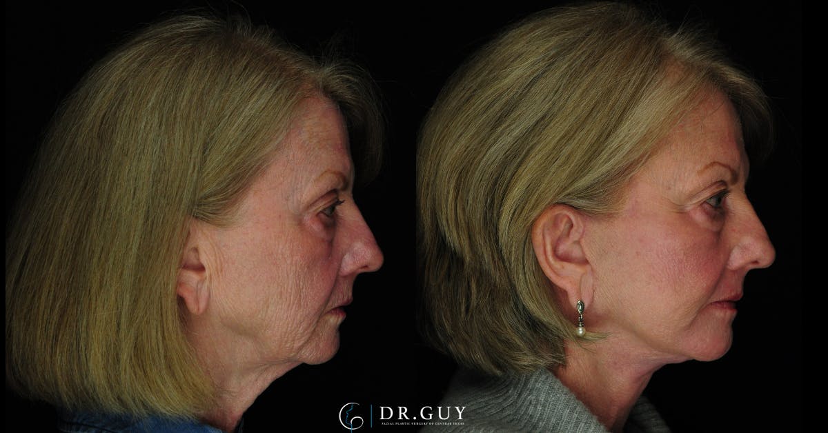 Facelift Before & After Gallery - Patient 342831 - Image 5