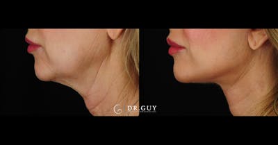 Mini Facelift Before & After Gallery - Patient 220973 - Image 1