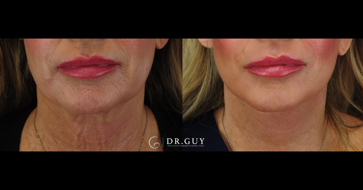 Mini Facelift Before & After Gallery - Patient 220973 - Image 2