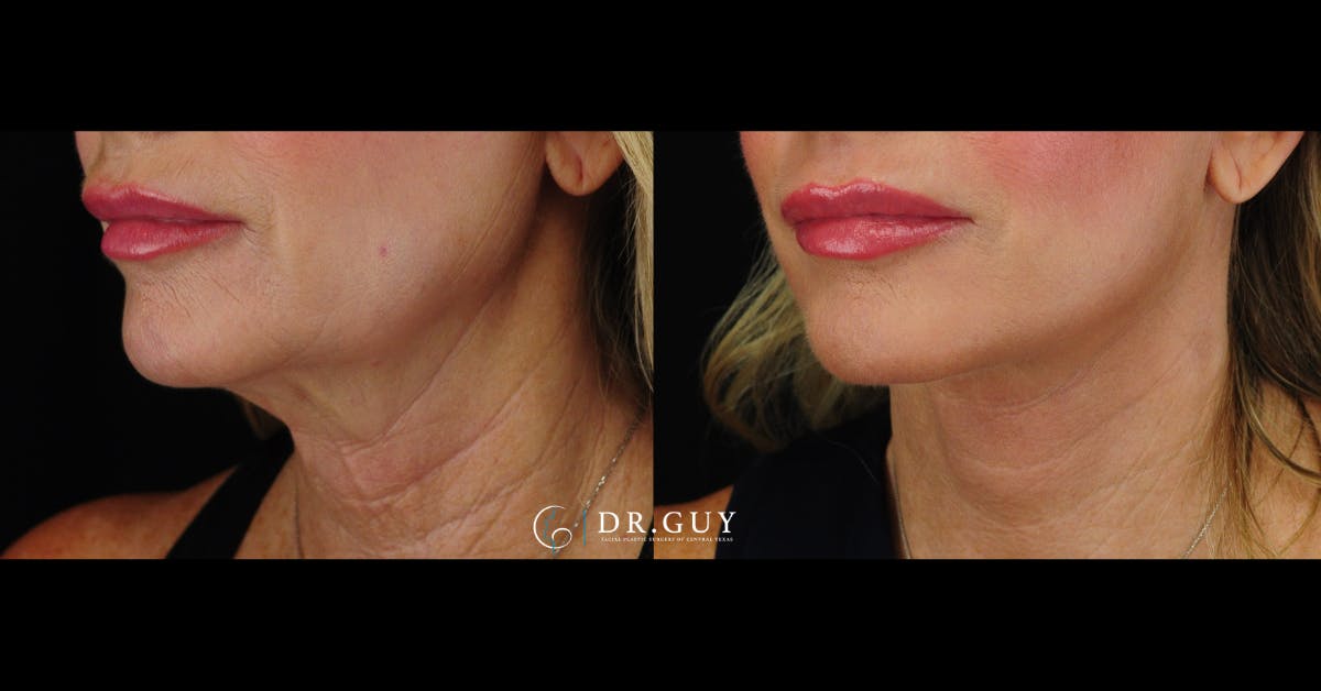 Mini Facelift Before & After Gallery - Patient 220973 - Image 3