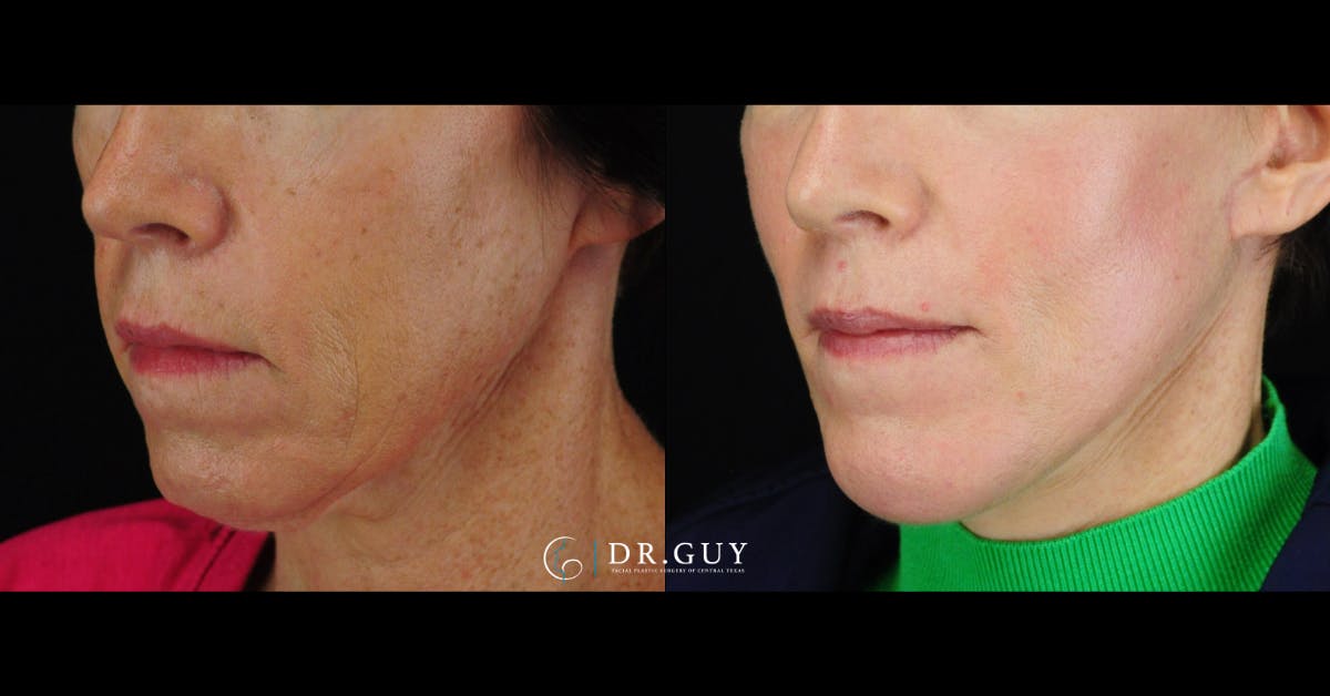 Mini Facelift Before & After Gallery - Patient 416662 - Image 2