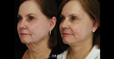 Mini Facelift Before & After Gallery - Patient 420799 - Image 1