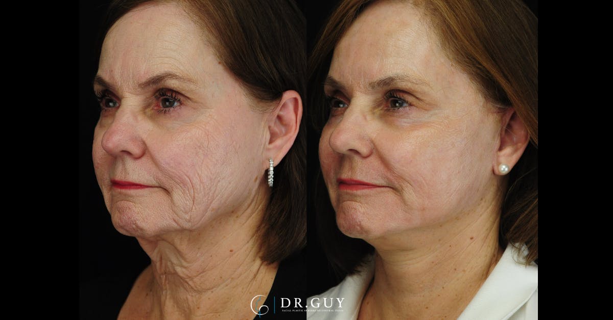 Mini Facelift Before & After Gallery - Patient 420799 - Image 1