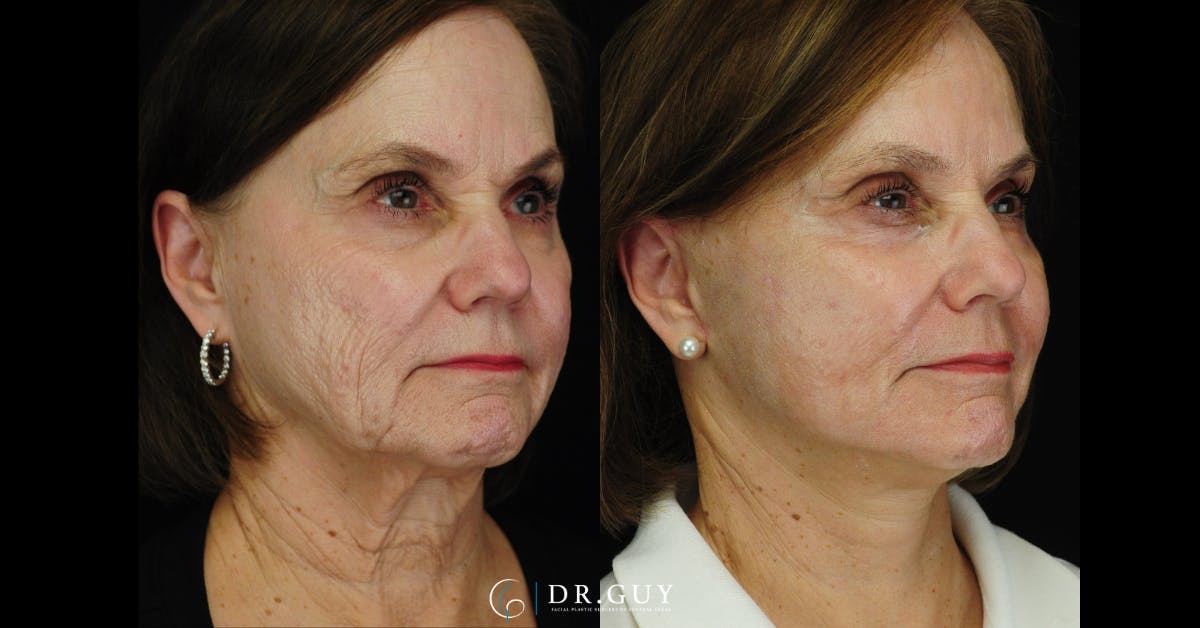 Mini Facelift Before & After Gallery - Patient 420799 - Image 2