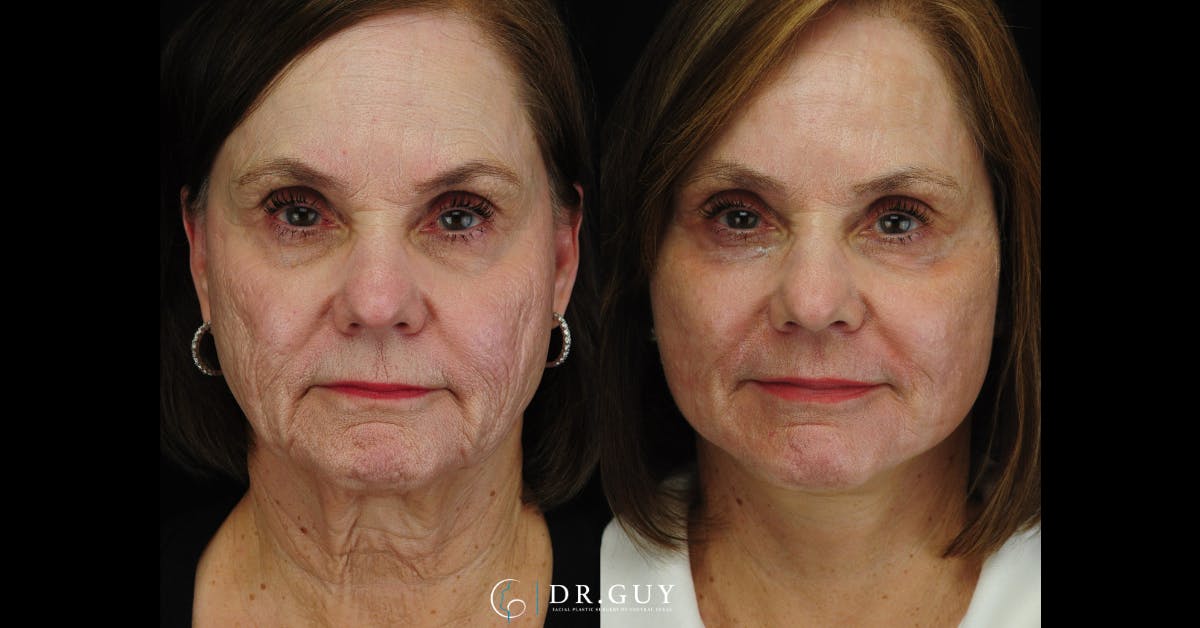 Mini Facelift Before & After Gallery - Patient 420799 - Image 3