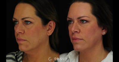 MyEllevate Before & After Gallery - Patient 224632 - Image 1