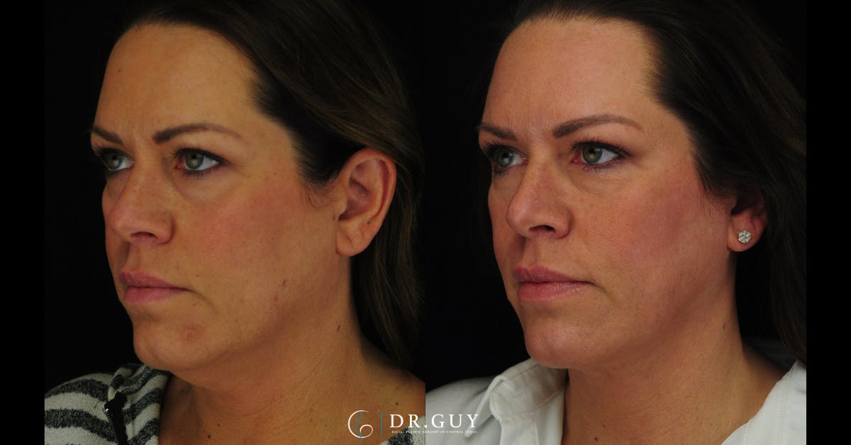 MyEllevate Before & After Gallery - Patient 224632 - Image 1