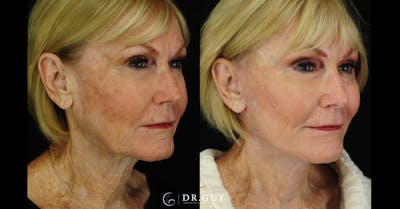 Mini Facelift Before & After Gallery - Patient 334067 - Image 1