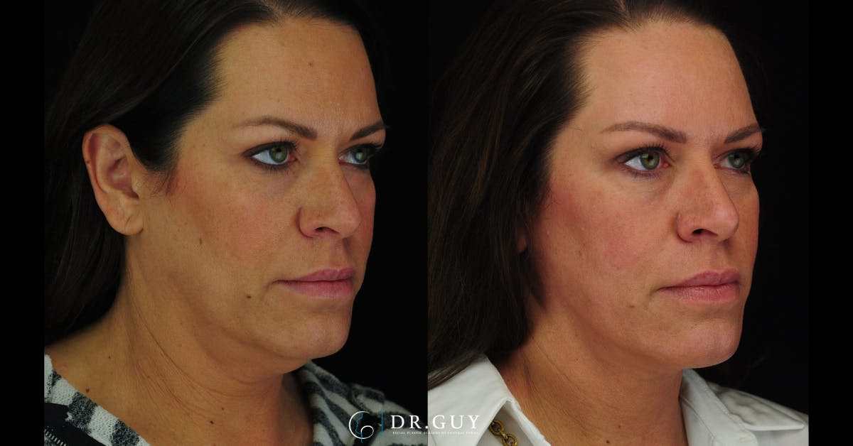 MyEllevate Before & After Gallery - Patient 224632 - Image 2