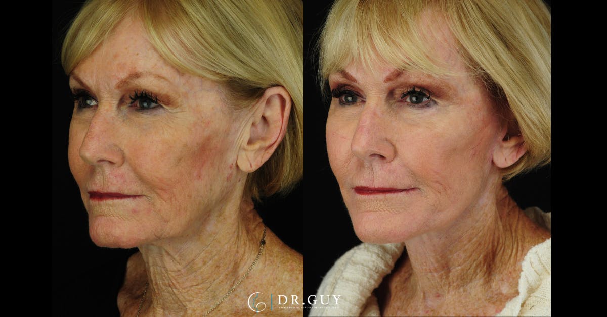 Mini Facelift Before & After Gallery - Patient 334067 - Image 2