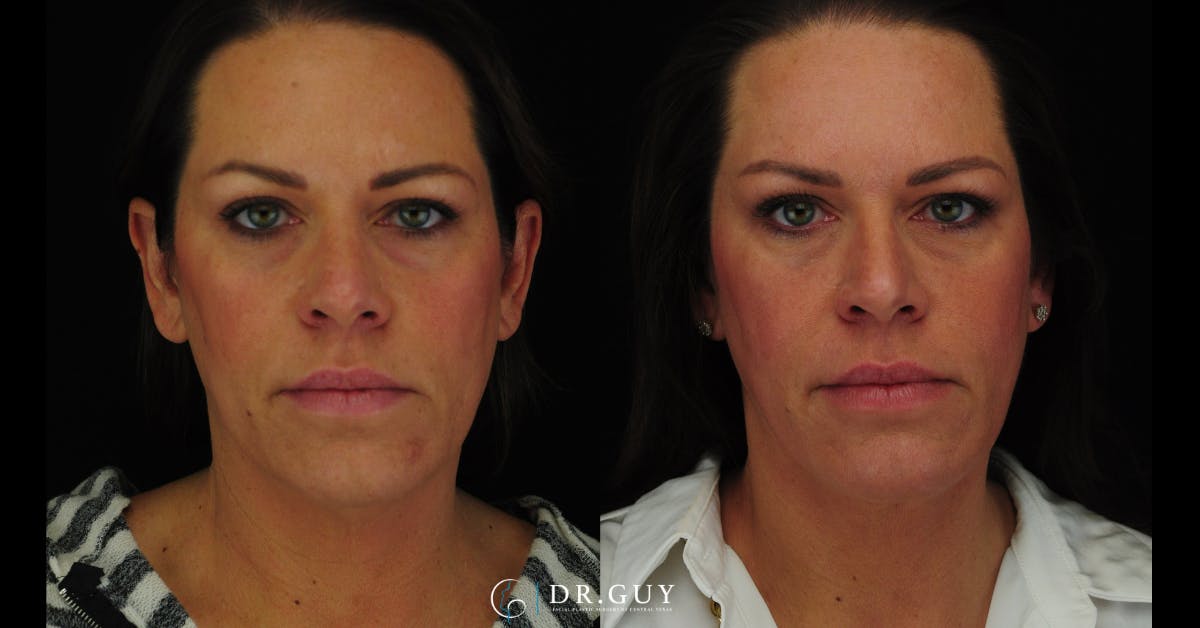 MyEllevate Before & After Gallery - Patient 224632 - Image 3