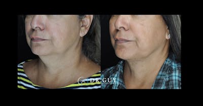 Neck Lift Before & After Gallery - Patient 111588 - Image 1
