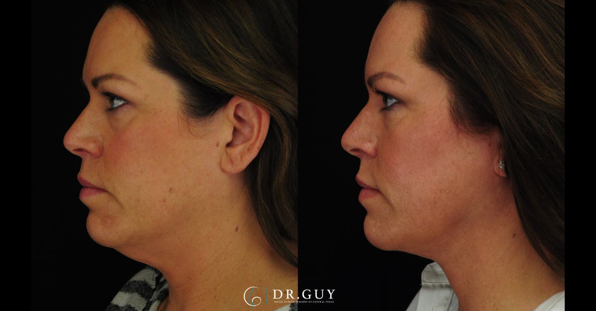 MyEllevate Before & After Gallery - Patient 224632 - Image 4