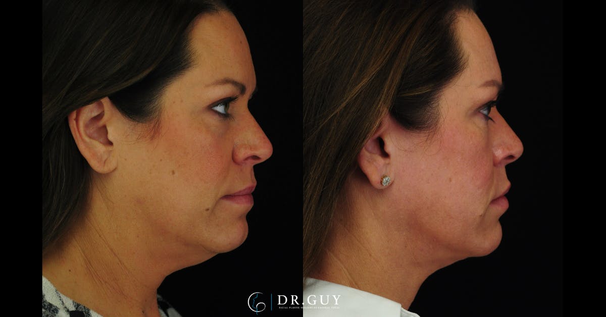 MyEllevate Before & After Gallery - Patient 224632 - Image 5