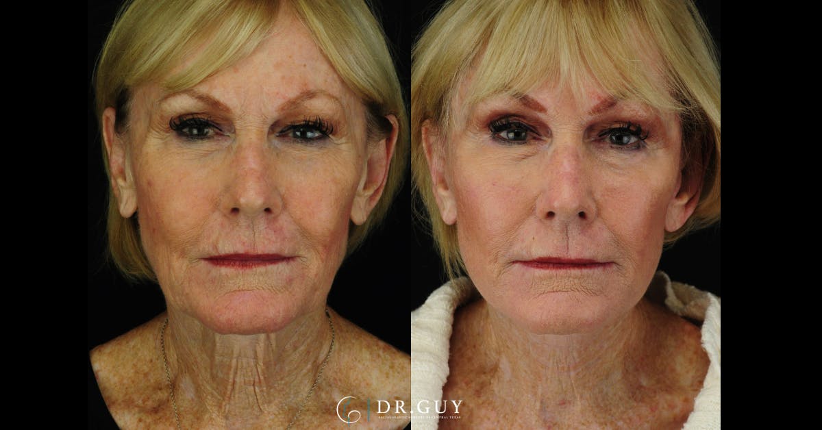 Mini Facelift Before & After Gallery - Patient 334067 - Image 3