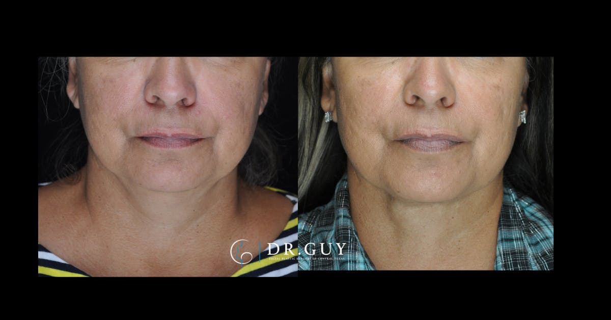 Neck Lift Before & After Gallery - Patient 111588 - Image 3